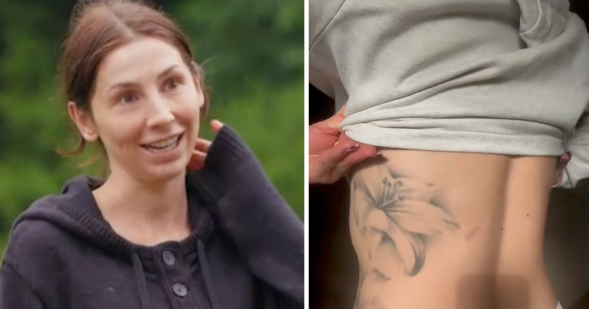 Angelica Johnsen visar upp sitt ärr efter olyckan
