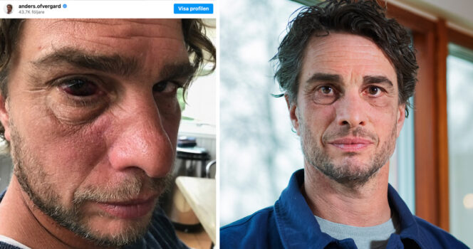 Anders Öfvergård har ett rött öga då ett blodkärl har spruckit